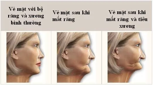 Trong rang implant va nhung dieu can biet Trong rang implant va nhung dieu can biet