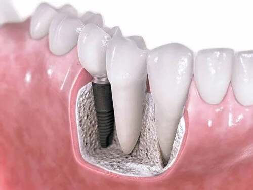trong-rang-implant-ngan-ngua-tieu-xuong-ham trong-rang-implant-ngan-ngua-tieu-xuong-ham