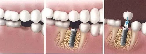 Trong răng implant nhu the nao Trong răng implant nhu the nao
