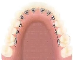 Niềng Răng Mặt Trong uy tín tại nha khoa viet uc Niềng Răng Mặt Trong uy tín tại nha khoa viet uc