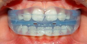 Niềng răng tháo lắp được đánh giá cao bởi thuận tiện trong vệ sinh răng miệng.