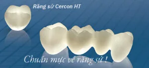 Bọc răng sứ được bao lâu phụ thuộc vào chất liệu răng sứ boc rang su cercon ht