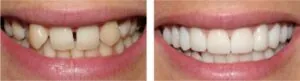 Bọc răng sứ cho răng thưa có đó bên bao lâu Bọc răng sứ cho răng thưa có đó bên bao lâu