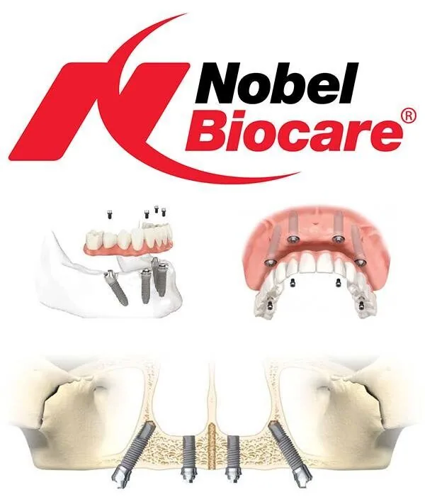 implant nobel biocare Implant nobel biocare
