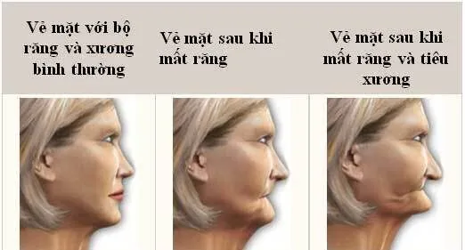 tai sao nen lua chon cay implant khi mat rang 0 tai sao nen lua chon cay implant khi mat rang 0
