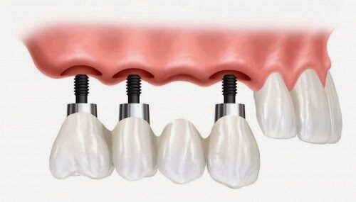 Tại sao nên lựa chọn cấy ghép implant khi mất răng?