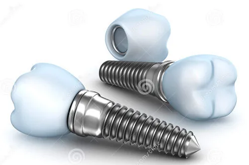 tai sao nen lua chon cay implant khi mat rang 2 tai sao nen lua chon cay implant khi mat rang 2