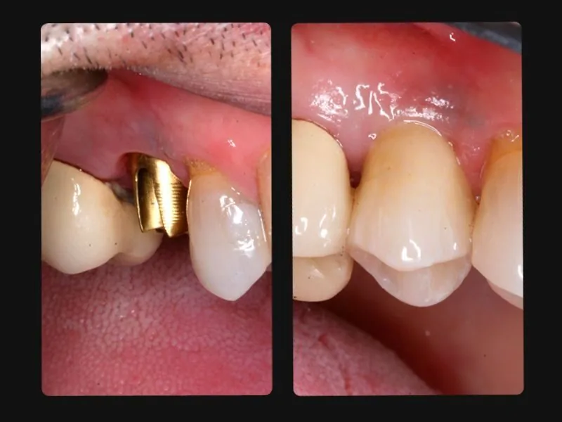 tai sao nen lua chon cay implant khi mat rang 3