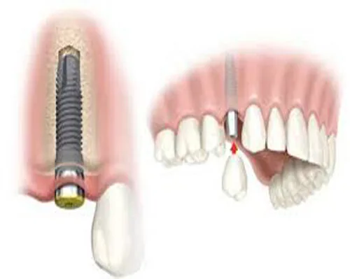 trong-implant-mat-bao-lau-2 trong-implant-mat-bao-lau-2