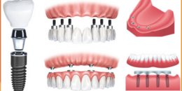 Trồng răng Implant toàn hàm ALL ON 4, ALL ON 6