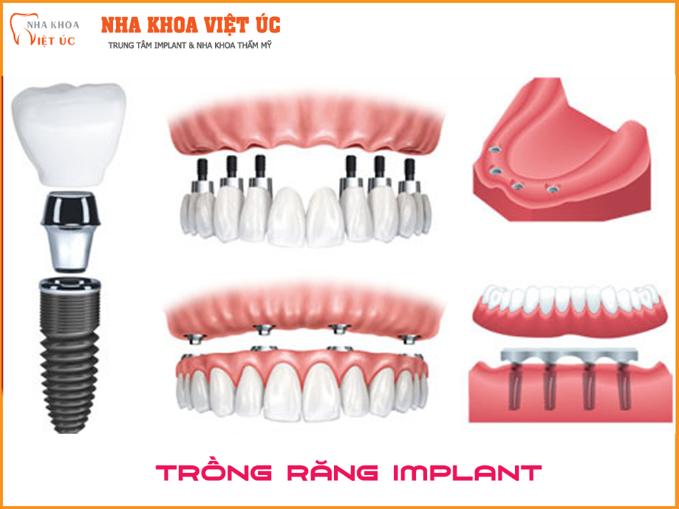 Trong rang Implant gia bao nhieu la cau hoi duoc nhieu nguoi quan tam