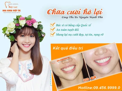 anh-cuoi-ho-loi-tai-nha-khoa-viet-uc