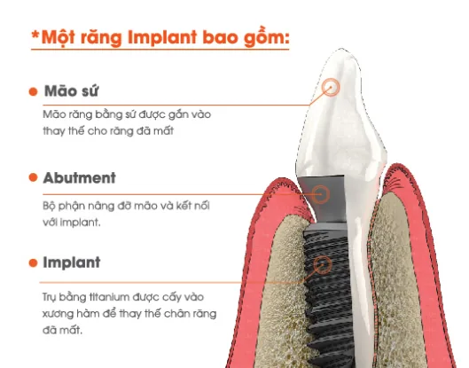 cau tao rang implant
