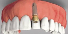 Giá trồng răng implant bao nhiêu là hợp lý?