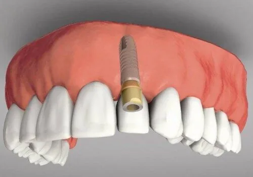 gia trong rang implant bao nhieu la hop ly gia trong rang implant bao nhieu la hop ly