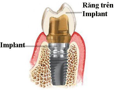 implant va nhung cau hoi lien quan