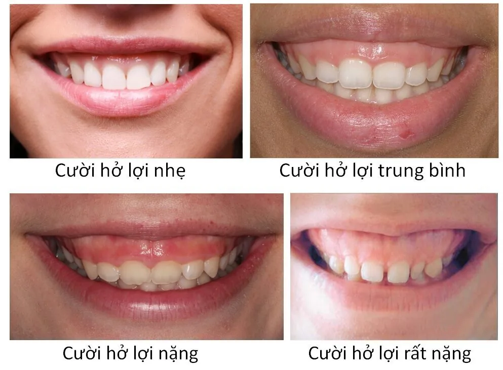 Những nguyên nhân gây cười hở lợi bạn cần biết