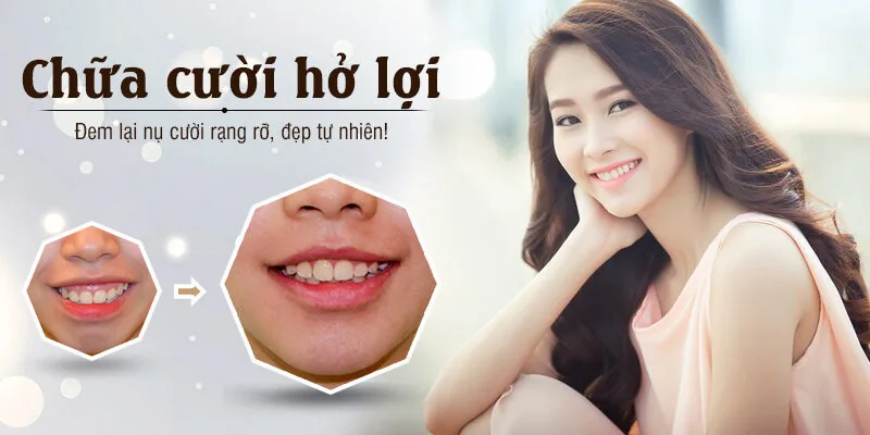 Phẫu thuật cười hở lợi ở đâu tốt để có nụ cười rạng rỡ? Phau thuat cuoi ho loi o dau tot de co nu cuoi rang ro