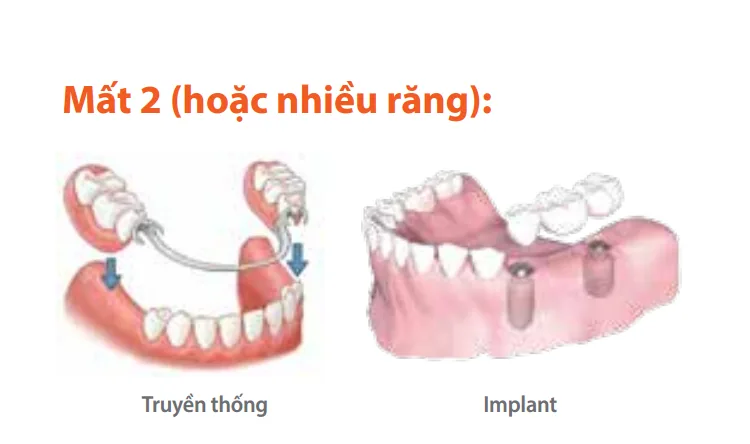 so sanh implant voi lam cau rang2