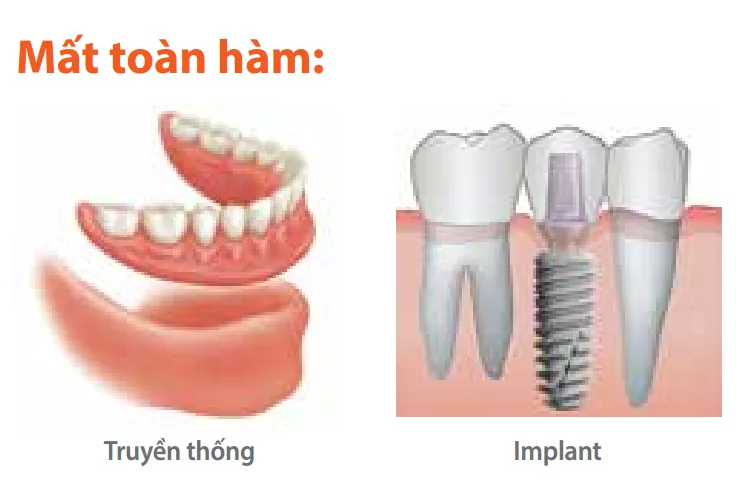 so sanh implant voi lam cau rang3