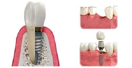 trong rang implant gia bao nhieu la hop ly 1 trong rang implant gia bao nhieu la hop ly 1