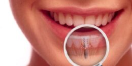 Cấy ghép răng implant giá bao nhiêu là hợp lý ?