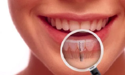 phuong phap trong rang implant