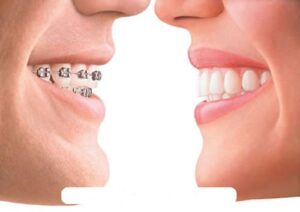ưu điểm của niềng răng mắc cài sứ là gì