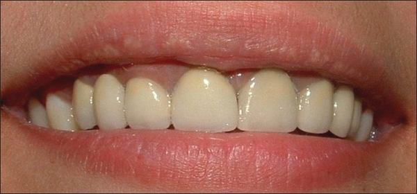 Sử dụng răng sứ Titan tiết kiệm chi phí hơn các loại răng sứ khác.