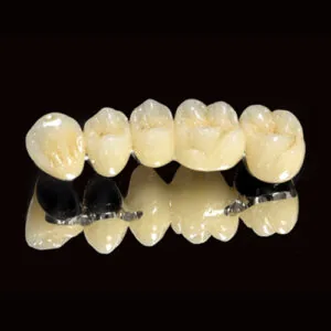 Bọc răng sứ Titan giá bao nhiêu