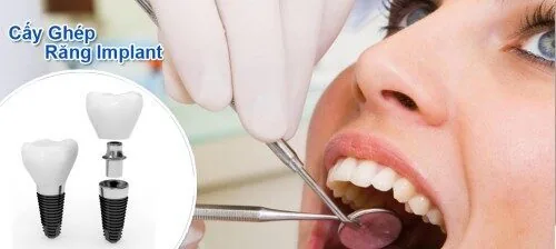 Cay ghep Implant co dau khong phu thuoc vao tay nghe bac si