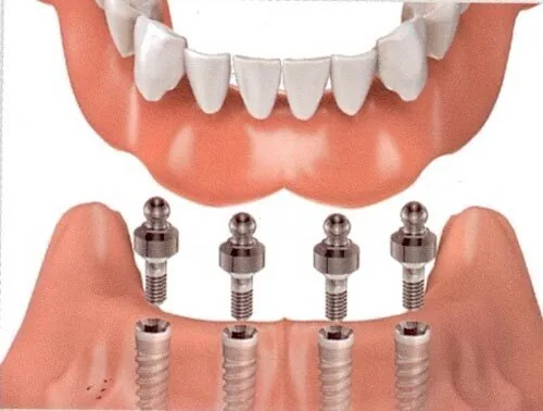 Cay ghep Implant co dau khong la cau hoi nhieu nguoi quan tam