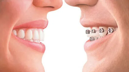 Niềng răng giá bao nhiêu