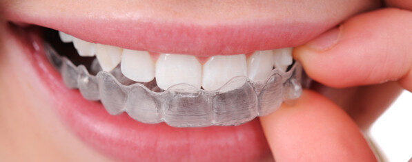 6 lý do vì sao niềng răng không mắc cài Invitech được ưa chuộng