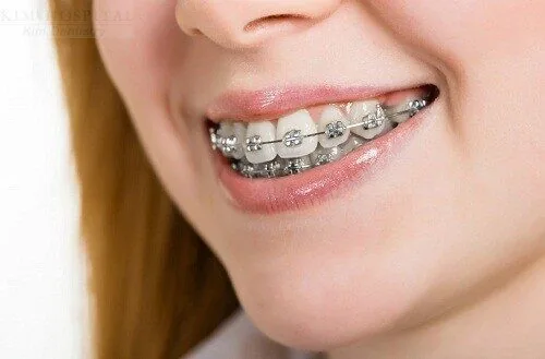 Niềng răng mắc cài là giải pháp tuyệt vời cho nụ cười đẹp