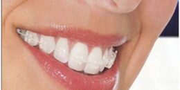 Niềng răng mắc cài sứ là gì?