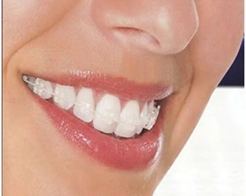 Niềng răng mắc cài sứ - Bước đột phá trong niềng răng mắc cài