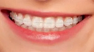 Niềng răng mắc cài sứ có tính thẩm mỹ cao
