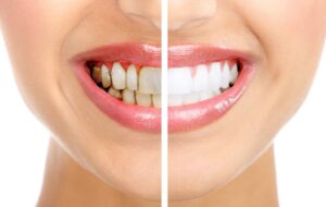 Tẩy trắng răng hiệu quả như thế nào?