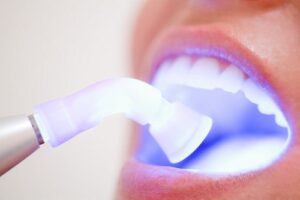 Bảng giá tẩy trắng răng tại nha khoa Việt Úc