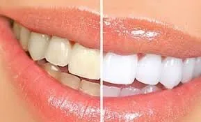 tay trang rang gia bao nhieu tay trang rang gia bao nhieu