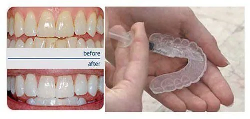 Cách tẩy trắng răng tại nhà bằng máng tẩy Cách tẩy trắng răng tại nhà bằng máng tẩy