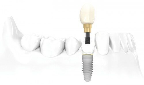 Cấy ghép răng Implant ở đâu tốt và uy tín nhất Hà Nội?