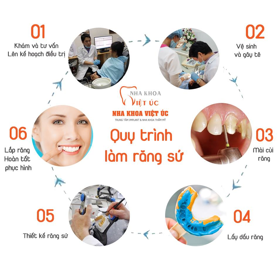 Quy trình bọc răng sứ tại nha khoa Việt Úc