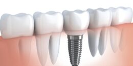 10 lợi ích hàng đầu khi cấy ghép răng implant