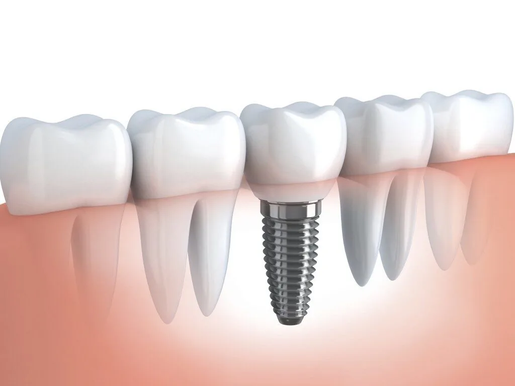 10 loi ich hang dau khi cay ghep rang implant 10 loi ich hang dau khi cay ghep rang implant