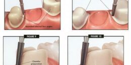 3 cách giảm đau khi mài răng bọc sứ tốt nhất