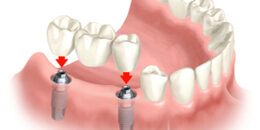 Cấy ghép Implant là gì? – Giải pháp tối ưu khắc phục mất răng
