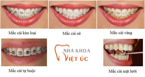 Các loại niềng răng mắc cài phổ biến nhất hiện nay