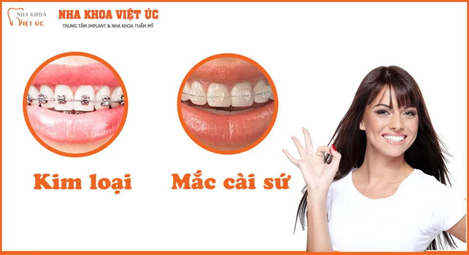 Niềng răng mắc cài kim loại và mắc cài sứ